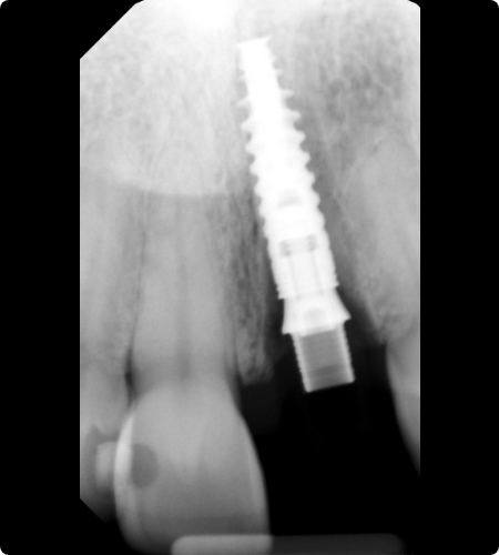 Immediate implant Immediate implant