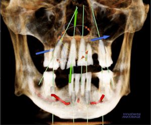 JantzAdam Implant 8 2opt 300x249 1 JantzAdam Implant 8 2opt 300x249 1