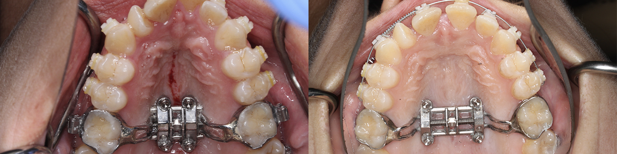 Maxillary Skeletal Expansion (MSE); Miniscrew Assisted Rapid