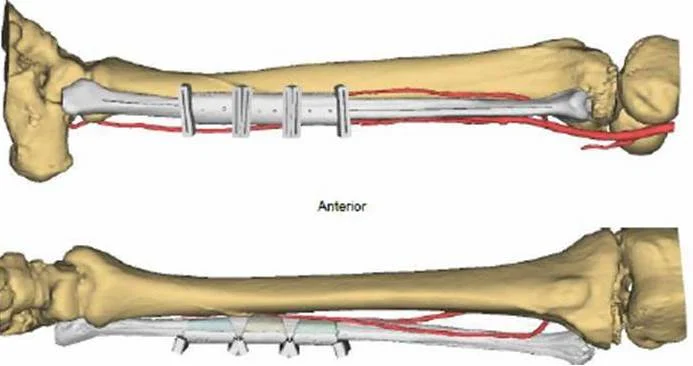 fibula fibula