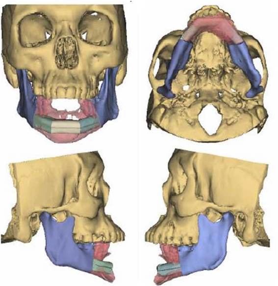 mandibular reconstruction1