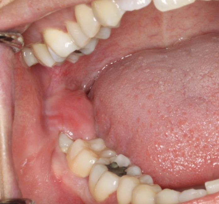 03 Pericoronitis 1