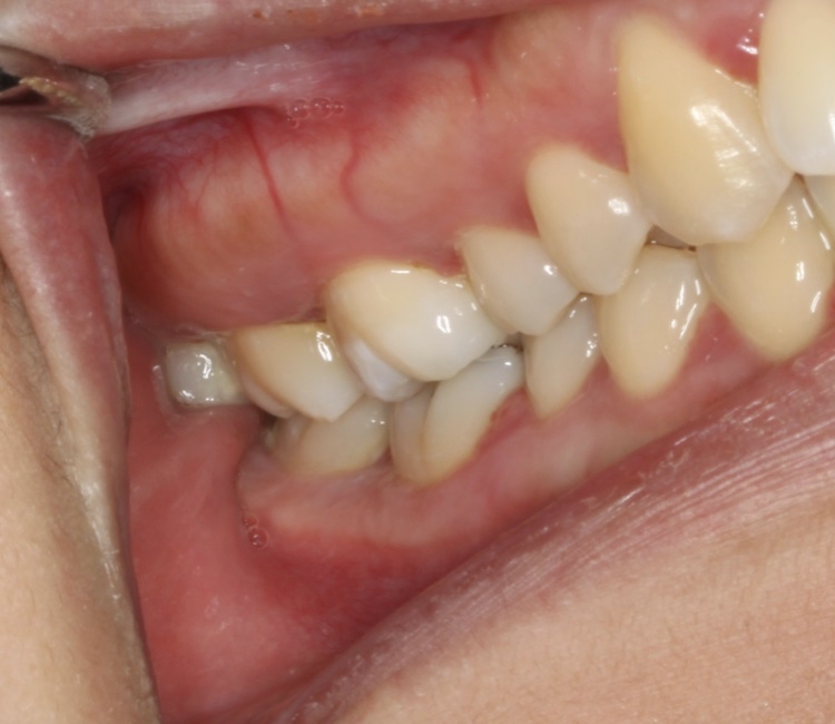 04 Pericoronitis 2