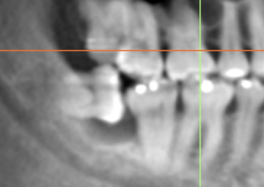 05 Periodontal Disease Bone loss