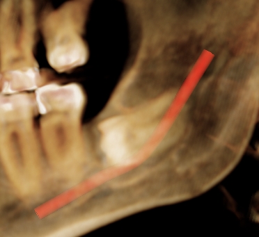 15 Coronectomy 2 15 Coronectomy 2