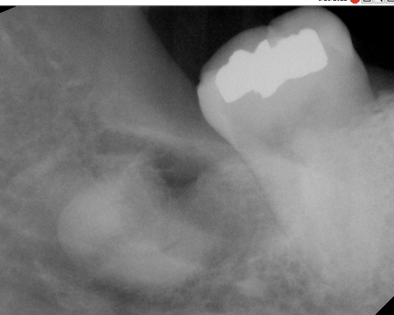 16 Coronectomy 3 16 Coronectomy 3