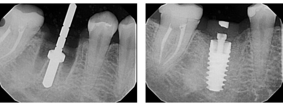 immediate molar implant 1 1 1024x576 1