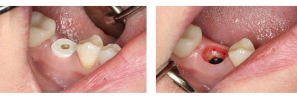 immediate molar implant 2 1024x576 1 immediate molar implant 2 1024x576 1